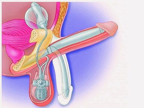 Enlargement sirit ku prosthesis penile