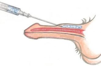 Hiji métode bahaya enlargement sirit ngagunakeun injections Vaseline